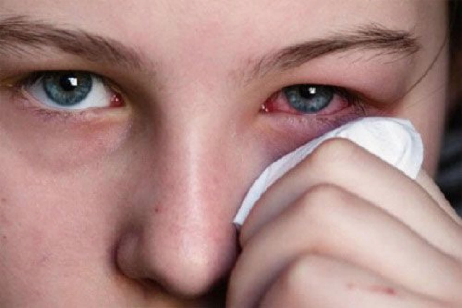 Bệnh viêm màng bồ đào gây sưng đỏ mắt