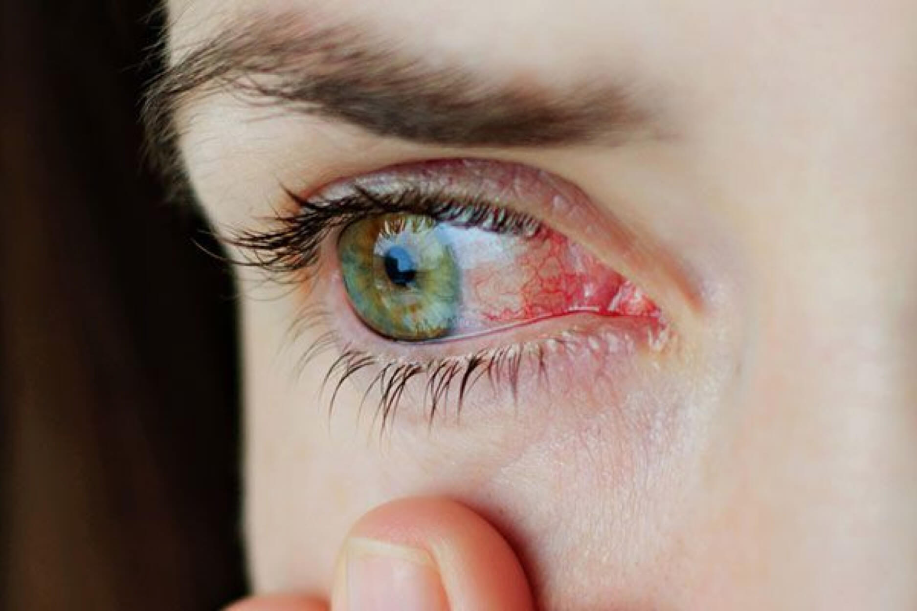 Mắt đỏ là dấu hiệu của bệnh gì? - Bệnh mắt đỏ